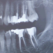 Tratamentul endodontic